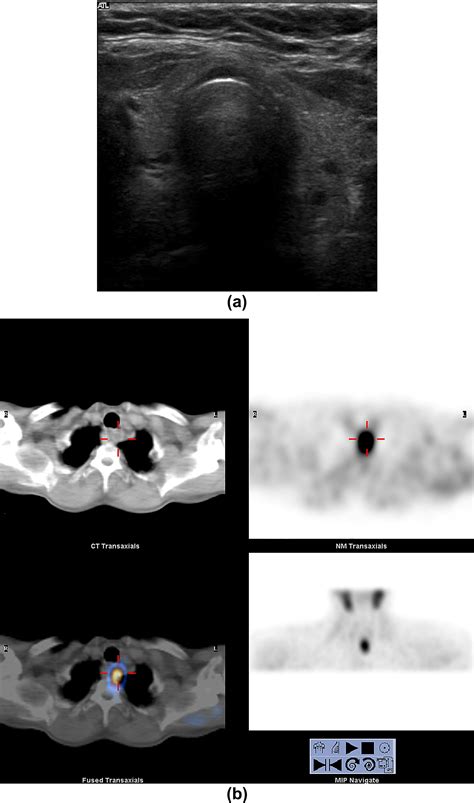 Clinical Utility Of Ultrasound And 99mtc Sestamibi Spectct For