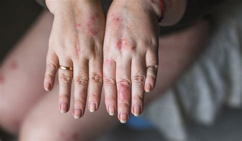 Why Psoriasis Takes A Heavier Toll On Women The Week