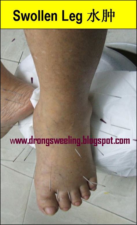 Tcm News Tcm Physician In Singapore Treat Swollen Legs
