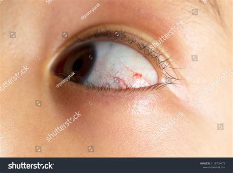 Boy Burst Blood Vessel Eye Closeup Stock Photo 1118709773 Shutterstock