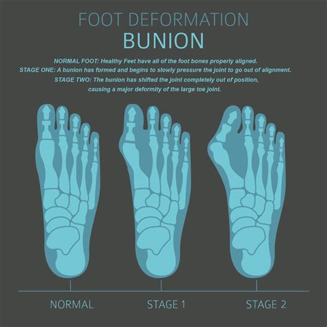 What Is A Foot Bunion Expert Guide To The Best Shoes For Bunions Kembeo