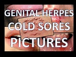 Early Stages of Herpes Pictures - YouTube