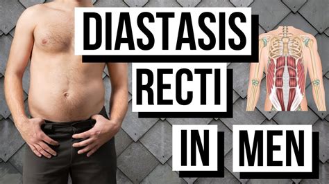 Diastasis Recti In Men Symptoms Causes And Treatment To Deal With