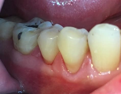 Gum Surgery Case 2 Menlo Park And Los Angeles Dental Excellence