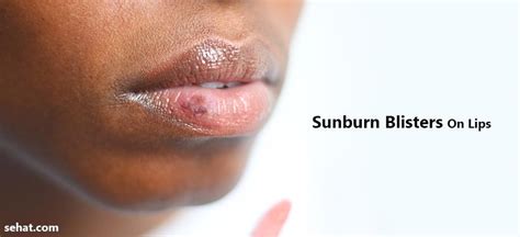 Sunburn Blisters On Lips Causes And Tips To Get Rid