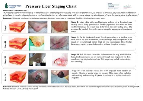 Pressure Ulcer Prevention Chart