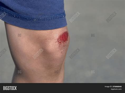 Bruised Wound On Knee Image And Photo Free Trial Bigstock