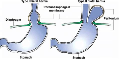 With Sliding Or Axial Hiatal Hernia There Is Thinning And Elongation Of