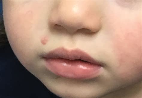 Pediatric Molluscum An Update Mdedge Dermatology