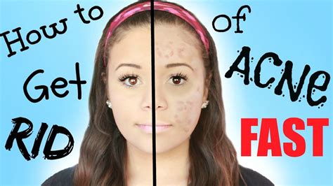 Diy How To Get Rid Of Acne Fast Krazyrayray Youtube