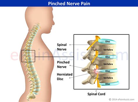 What Is A Pinched Nerve Cause And Symptoms Of A Pinched Nerve