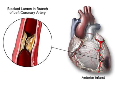 En pacientes con enfermedad coronaria avanzada, la cirugía resultó en un benefició significativo en. Infarto de miocardio | Enfermedades del cuerpo humano