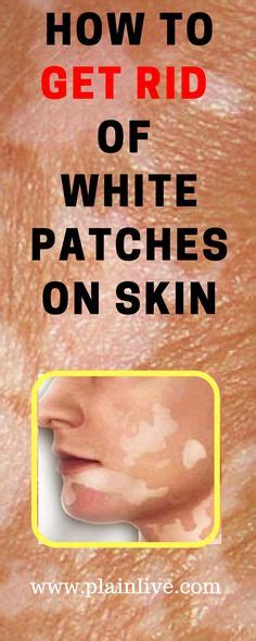 5 Ways To Get Rid Of White Spots On The Face Of Your Child Tips For
