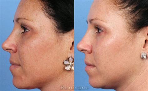 Even Skin Tone And Glowing Results Rejuvent Medical Spa Scottsdale