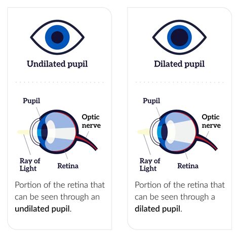 What Is Eye Dilation And Why Is It So Important