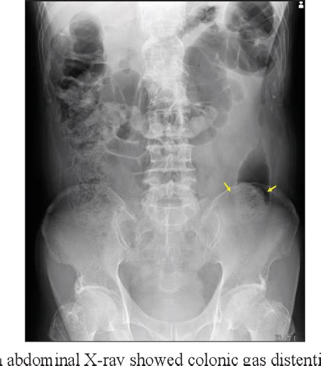 Figure 1 From A Case Of Colonic Fecal Impaction Caused By Excessive