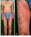Figure 1 from Lichenoid Drug Eruption after Low-Dose Imatinib Mesylate ...