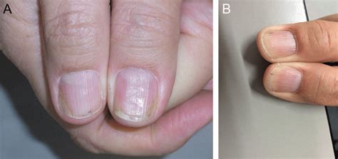 Onycholysis Psoriasis