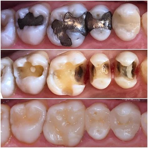 Replacing Old Amalgam Fillings With White Composite Fillings Dental