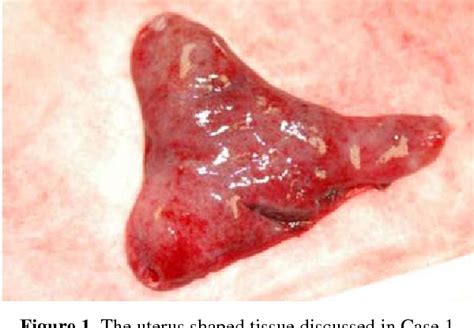 Pdf Membranous Dysmenorrhea A Case Series Semantic Scholar