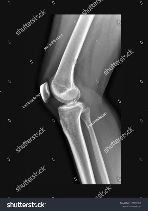 Film Xray Lateral Knee Radiograph Show 스톡 사진 1424668898 Shutterstock