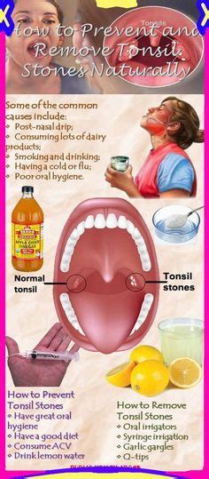 Pin On Tonsil Stone Remedies