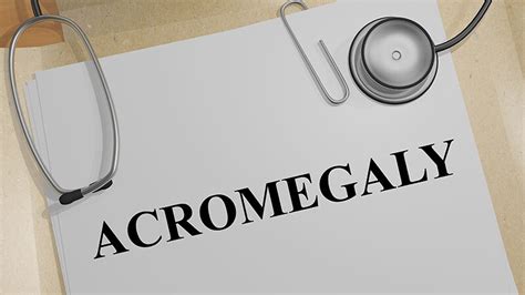 patients and doctors on different pages for acromegaly symptoms 11340 hot sex picture