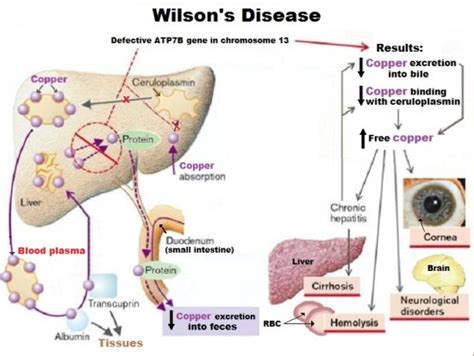 Wilson Disease Causes Investigations Homeopathic Treatment
