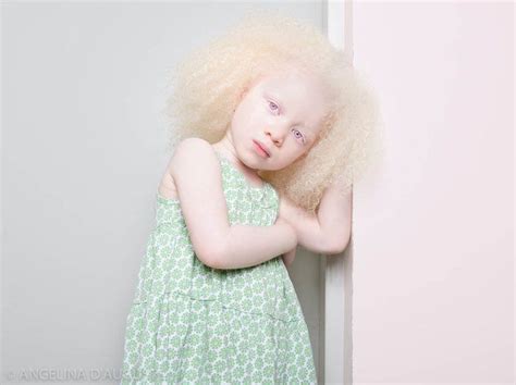 13 Spellbinding Portraits Of People With Albinism Albino Girl