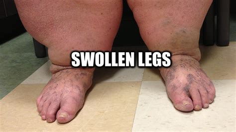 Do You Have Swollen Legs Read About Causes Diagnosis And Treatment