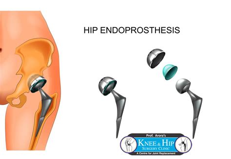 Pin On Hip Replacement