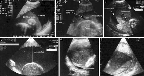 Prenatal Sonographic Assessment And Perinatal Course Of Ichthyosis
