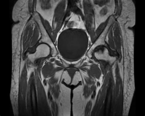 Avascular necrosis versus other diseases of the hip: Avascular Necrosis (Osteonecrosis) of the Hip - Robert Howells