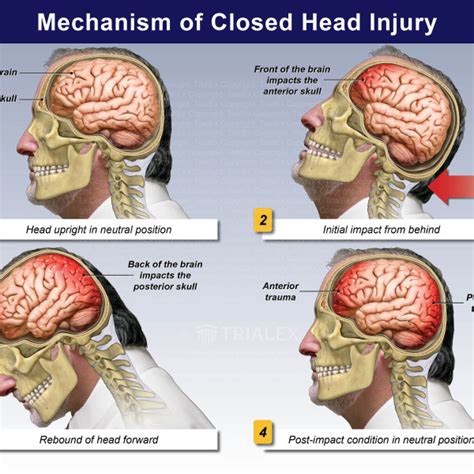 Mechanism Of Closed Head Injury Trialexhibits Inc