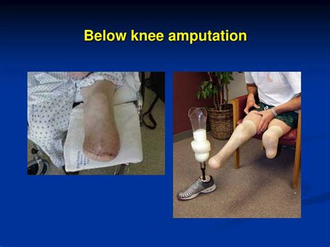 Types Of Below Knee Amputation