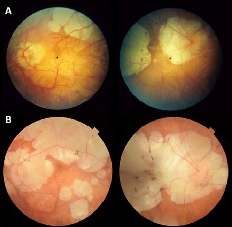 Fundus Photographs Of Both Eyes Taken At An Interval Of 26 Years From