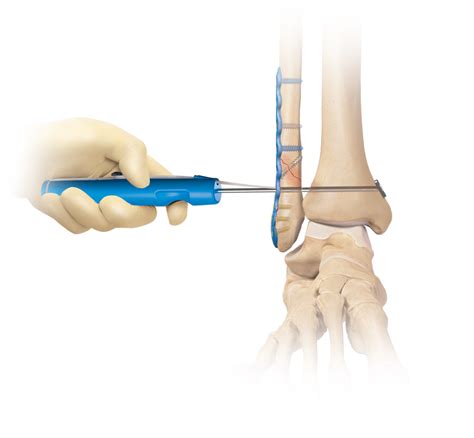 Arthrex Syndesmosis Tightrope® Xp Implant System