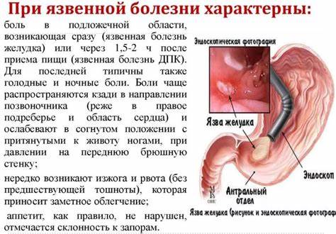Какие диеты язва желудка Как лечить язву желудка в домашних условиях вне обострения | Здравие Как лечить язву желудка в домашних условиях вне обострения | Здравие Какие диеты язва желудка