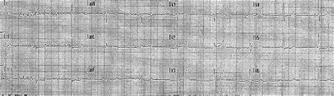 I want to remove it. Dr. Smith's ECG Blog: A Very Subtle LAD Occlusion....T ...