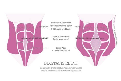 The Gap Isnt The Problem The Lack Of Function Is Diastasis Recti