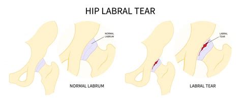 Non Surgical Treatment Of Acetabular Or Hip Labral Tears Caring
