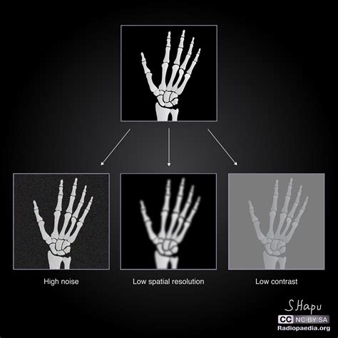 Radiographic Image Quality Diagrams Radiology Case Radiopaedia Org