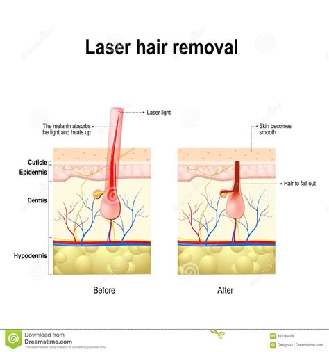 How long does it take hair to fall out after a laser hair removal treatment? Laser Hair Removal. Vector Diagram Stock Vector ...