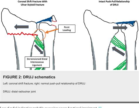 Pdf Current Concepts Corrective Osteotomy For Extra Articular