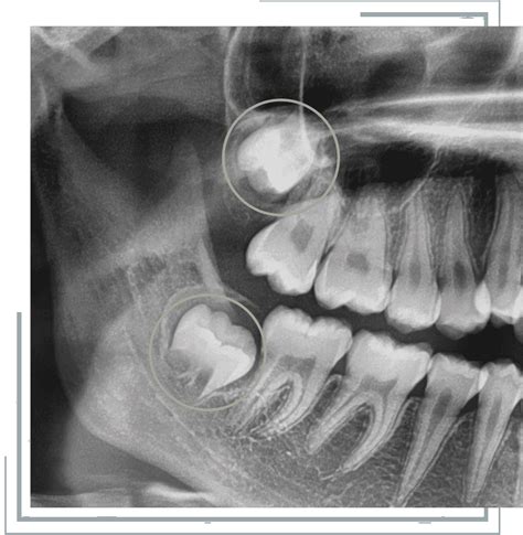 Wisdom Teeth Amesbury Ma Third Molars Impacted Tooth