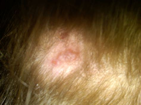 I Have A Thick Scab On The Back Of My Scalp Location Is Centered