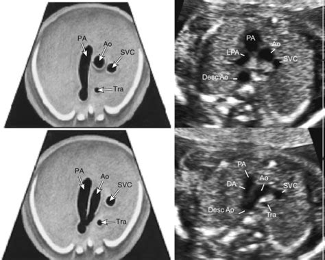 Sonographic Evaluation Of The Fetal Heart Obgyn Key