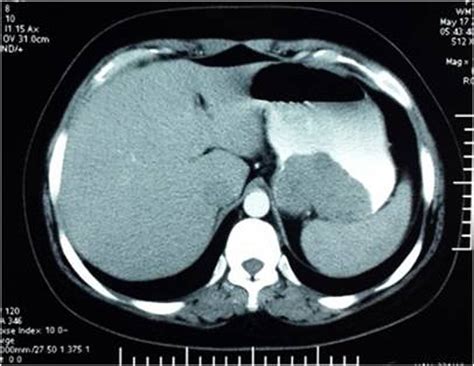 Abdominal Ct Scan Showing The Presence Of A Cystic Tumor Of Cm With A