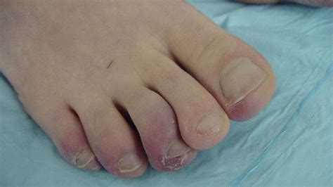 A 43 Year Old With Painful Discolored Toes Page 3