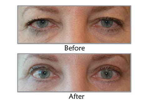 Eyelid Surgery For A Tired Appearance